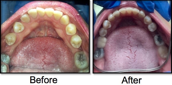 Dental Braces Treatment: Before And After Comparison