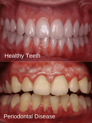 Example Of a Smile With Periodontal Disease