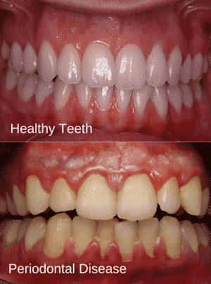 mild periodontitis