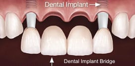 High Quality Dental Implant Supported Bridge Procedures In New York