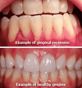 Example Of Gingival Recession And Healthy Gingiva