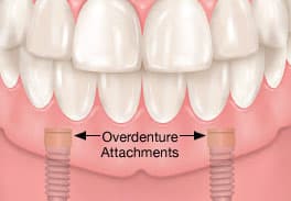 Professional Overdenture Implants In Washington Heights, NY