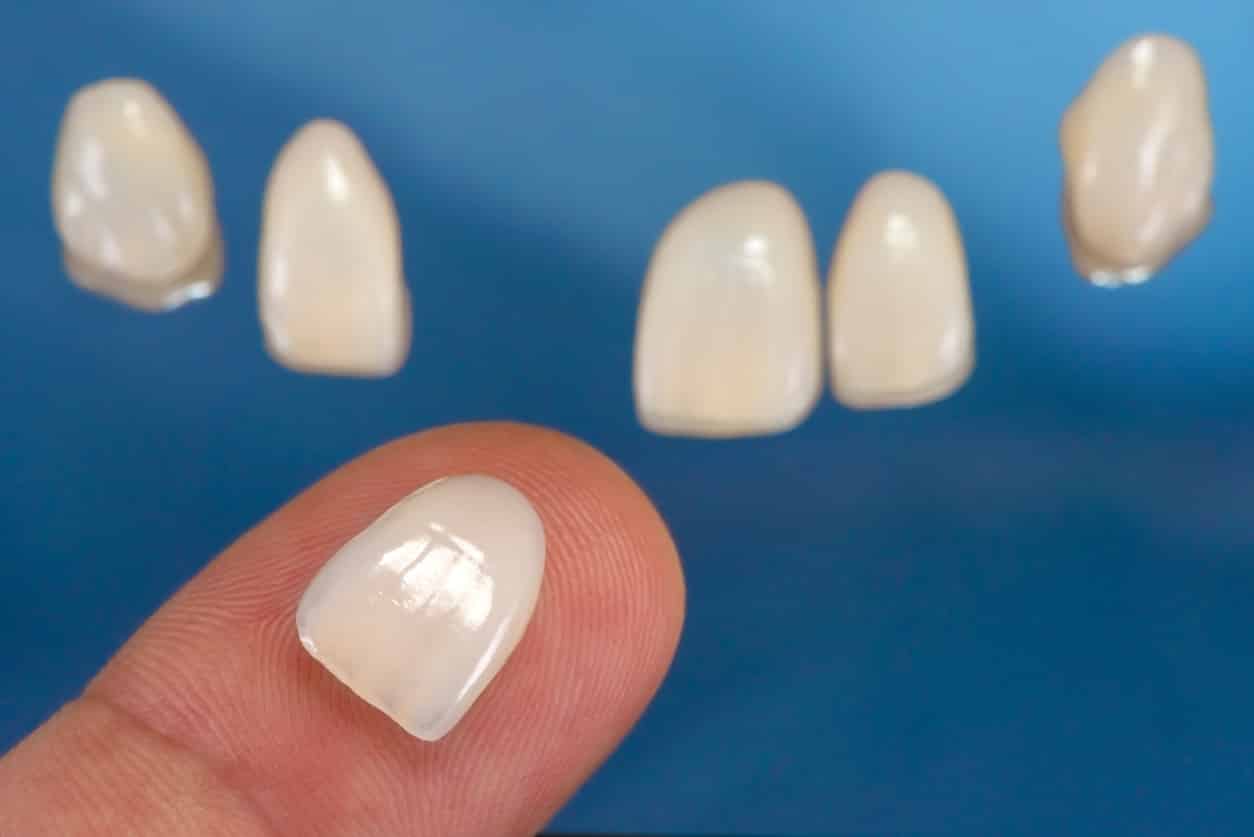 Dental veneers with one veneer on hand finger, closeup photo with blue background. Selective focus.