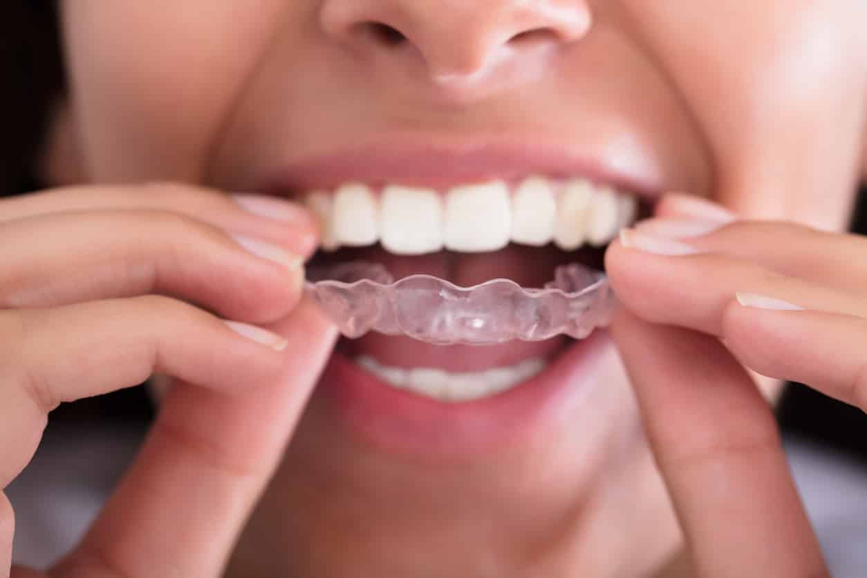 closeup of woman putting invisalign aligner on teeth