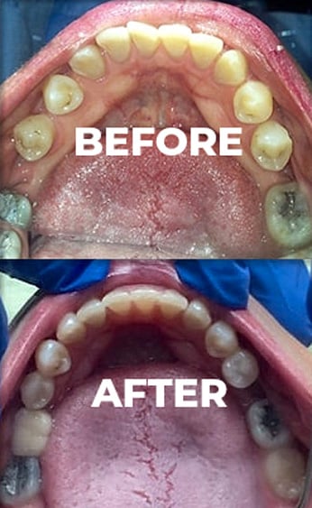 Before & After braces results