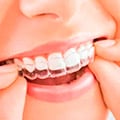 Highly Effective Invisalign Service For Teeth Straightening
