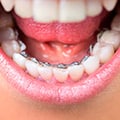 Lingual Braces For Teeth Correction