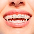 Traditional Braces & Orthodontic Elastics For Correct Teeth Positioning