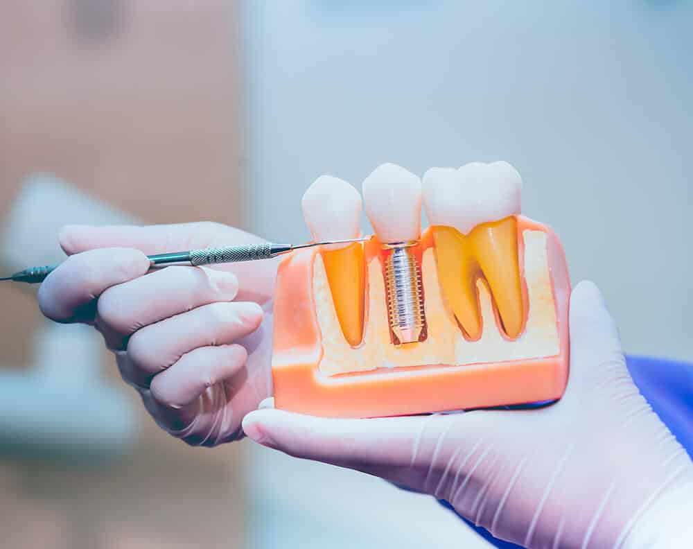 Experts In All On 4 Dental Implants Near Hudson Heights