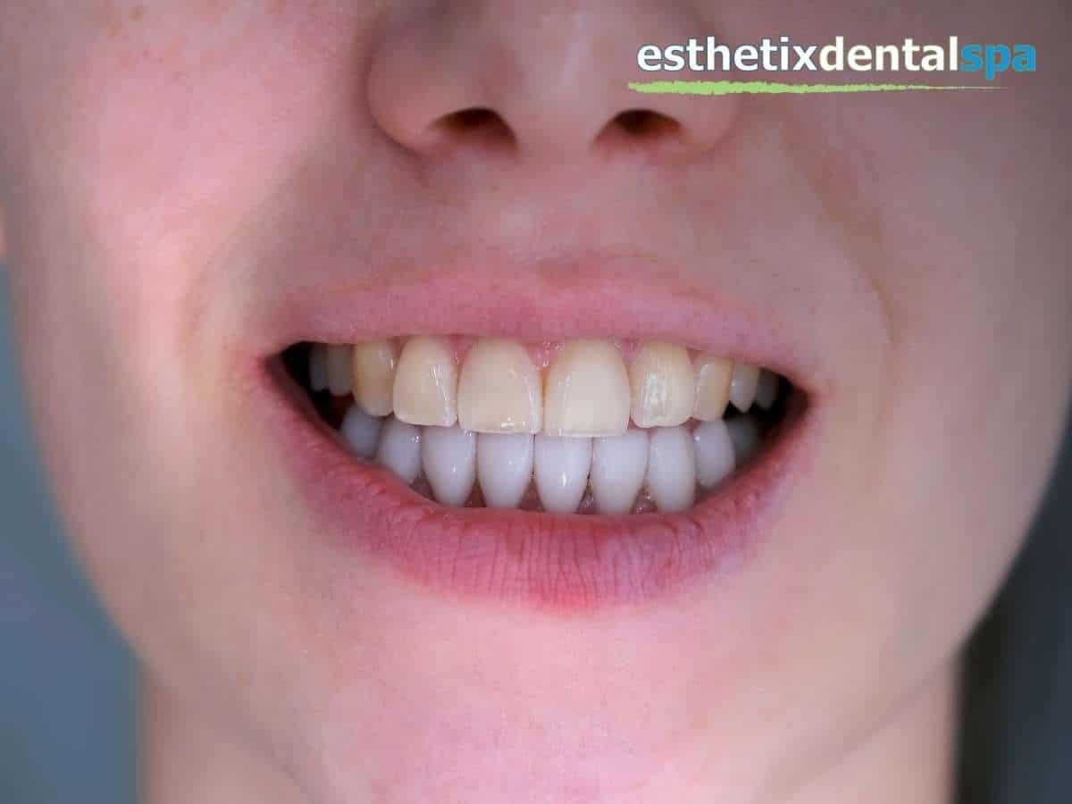 Veneers on a male patient smiling