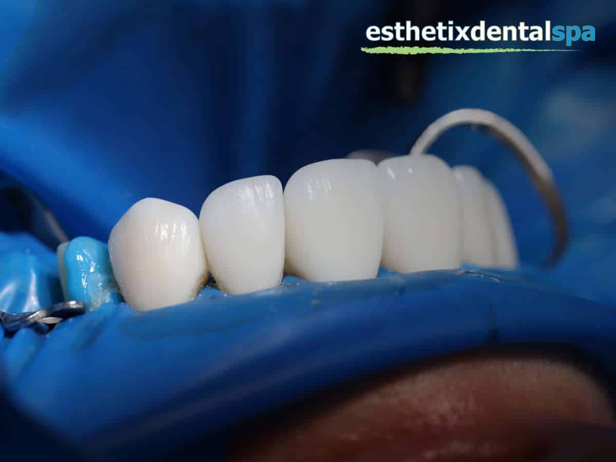 Washington Heights dentist Dental Implant Bridge