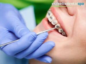 Close-up of teeth with braces for orthodontic treatment