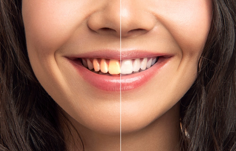 Close-up Of Smiling Woman Teeth Before And After Whitening