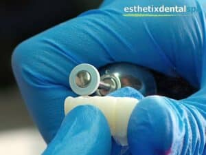 Dental professional preparing a dental implant for placement