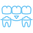 Implant-supported bridges providing a permanent solution for missing teeth