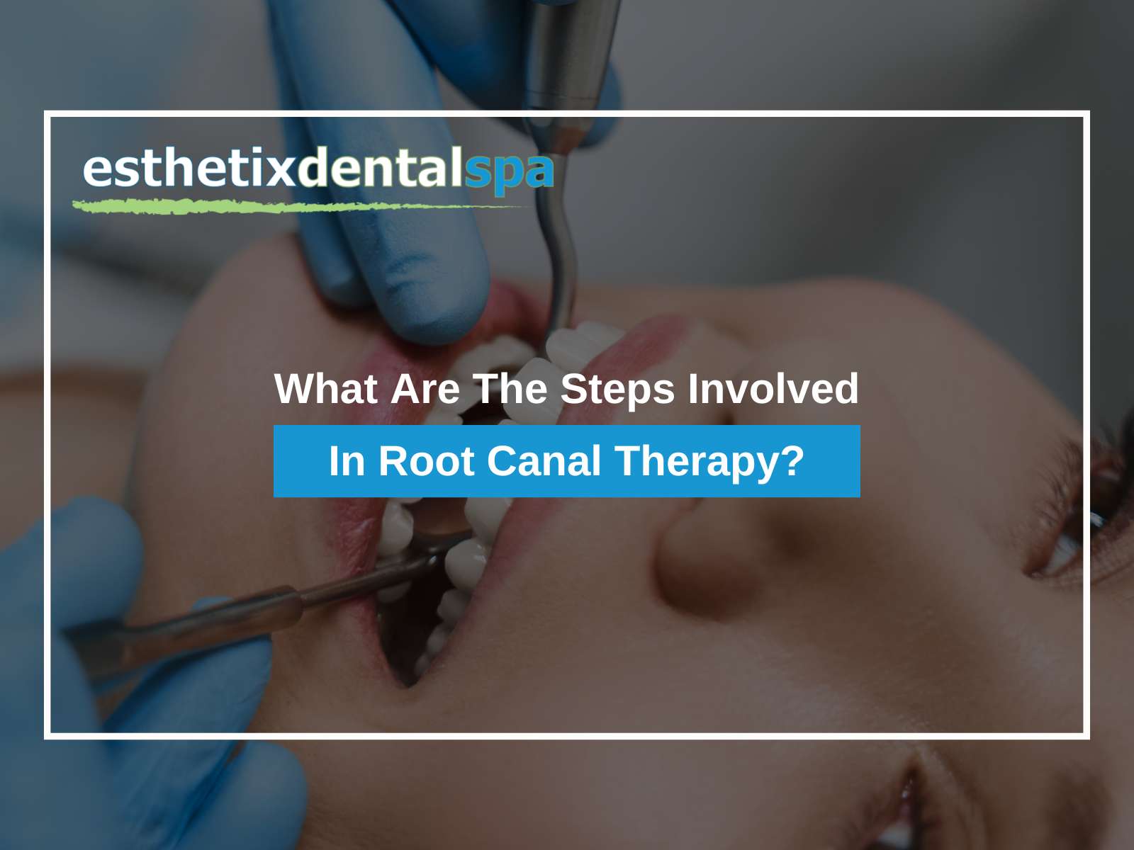 What Are The Steps Involved In Root Canal Therapy?